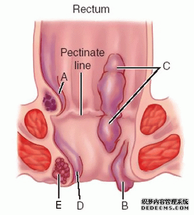 内痔疮症状与其他疾病有哪些不同？