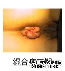 专家教你如何预防混合痔