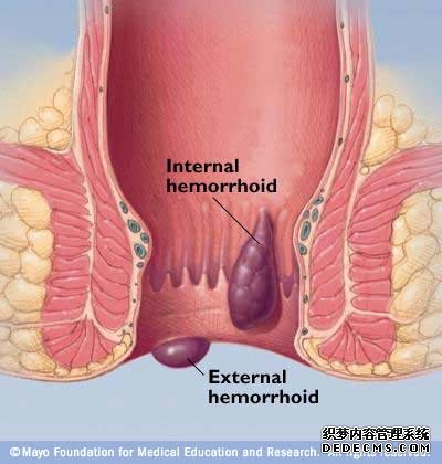 内痔症状有哪些呢