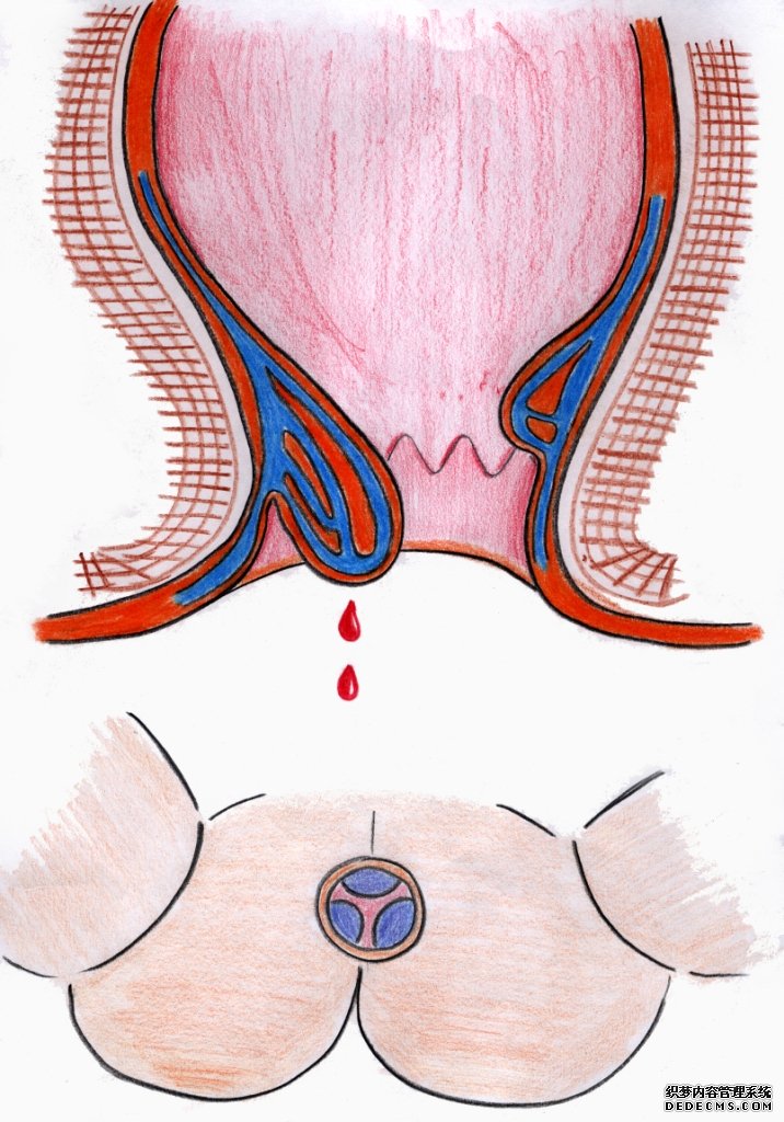 肛肠疾病怎么导致便血的
